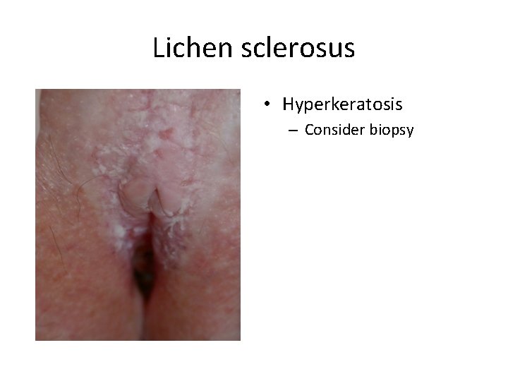 Lichen sclerosus • Hyperkeratosis – Consider biopsy 