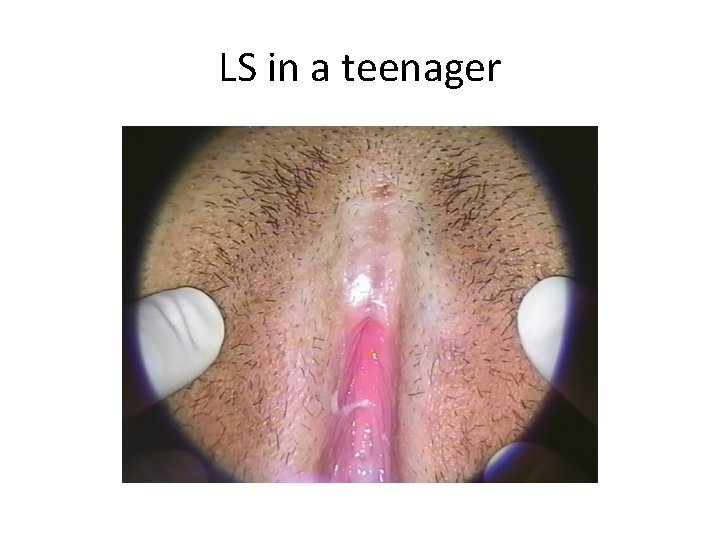 LS in a teenager 