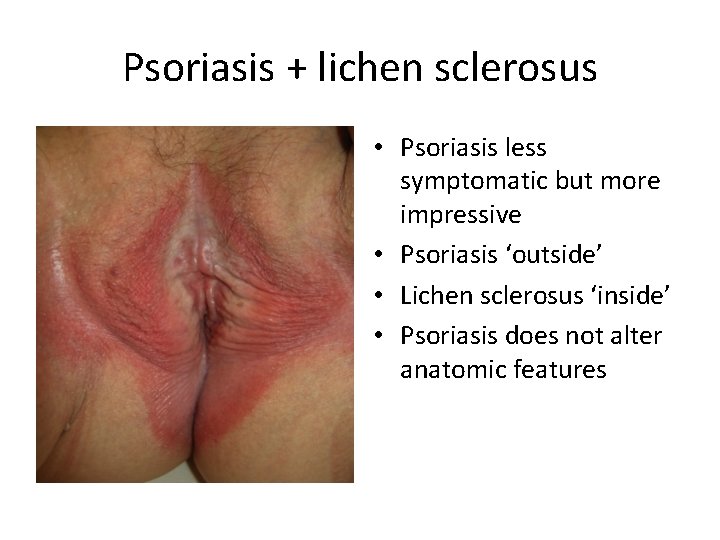 Psoriasis + lichen sclerosus • Psoriasis less symptomatic but more impressive • Psoriasis ‘outside’