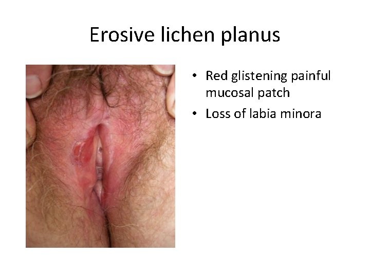 Erosive lichen planus • Red glistening painful mucosal patch • Loss of labia minora