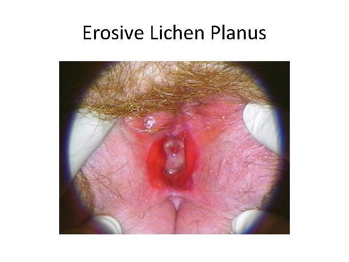 Erosive Lichen Planus 