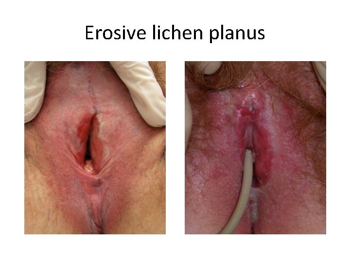 Erosive lichen planus 