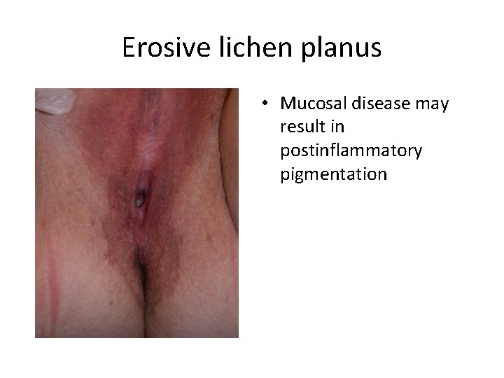 Erosive lichen planus • Mucosal disease may result in postinflammatory pigmentation 