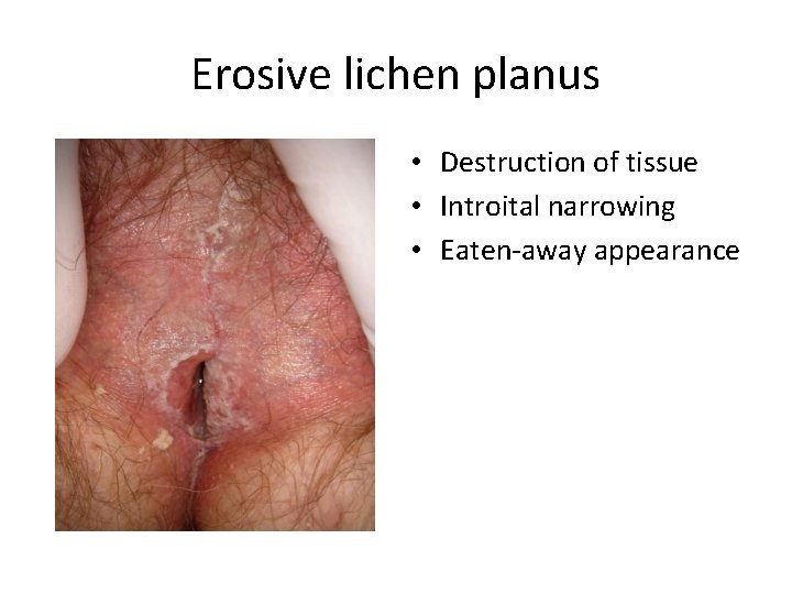 Erosive lichen planus • Destruction of tissue • Introital narrowing • Eaten-away appearance 