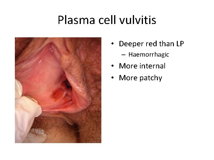 Plasma cell vulvitis • Deeper red than LP – Haemorrhagic • More internal •