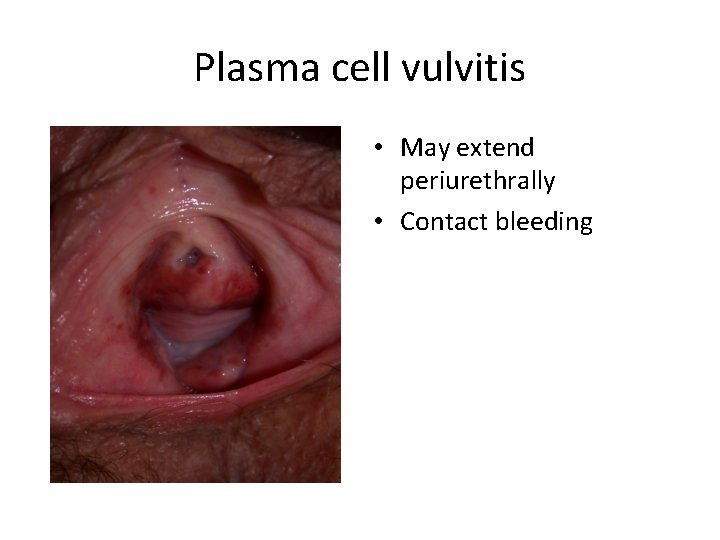 Plasma cell vulvitis • May extend periurethrally • Contact bleeding 