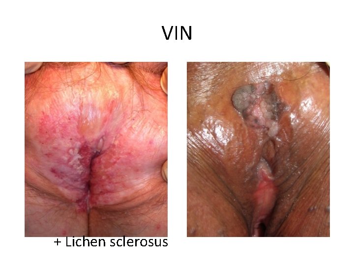 VIN + Lichen sclerosus 
