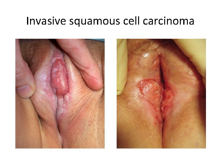 Invasive squamous cell carcinoma 