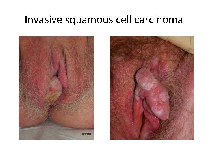 Invasive squamous cell carcinoma 