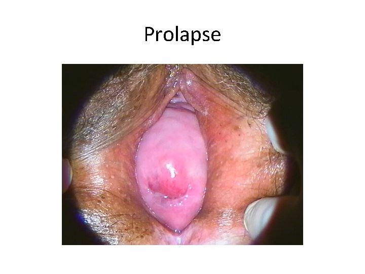 Prolapse 