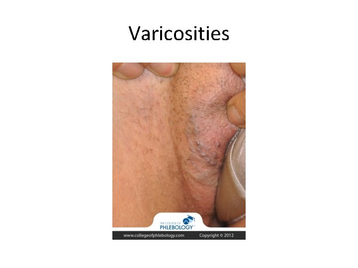 Varicosities 