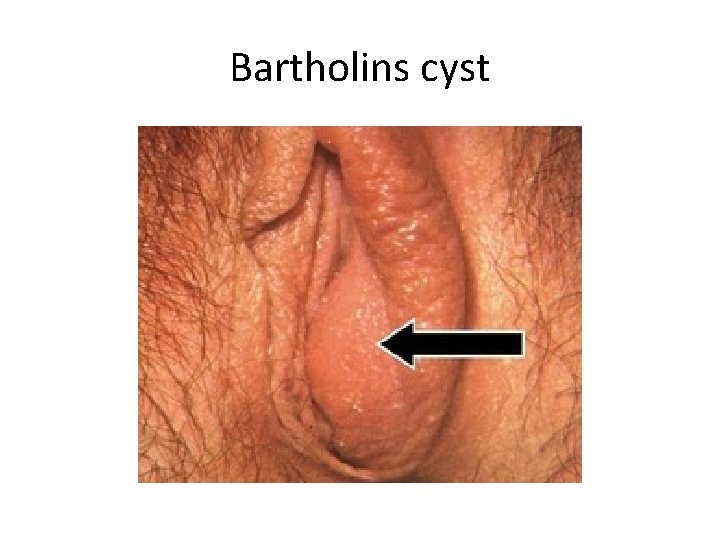 Bartholins cyst 