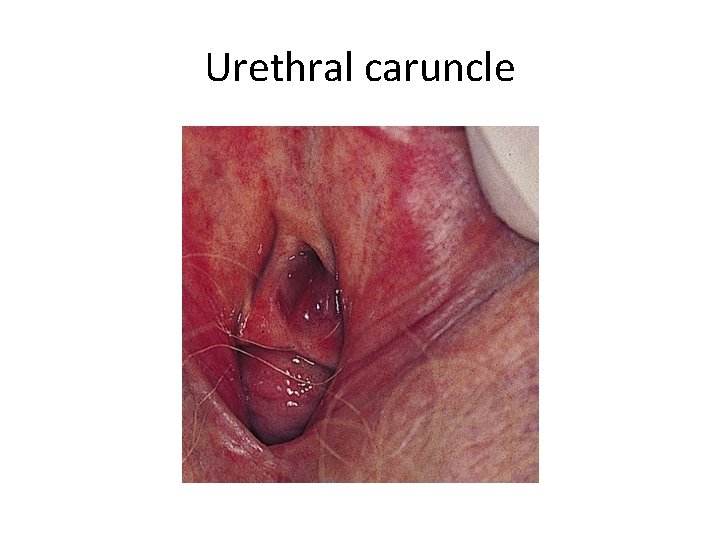 Urethral caruncle 