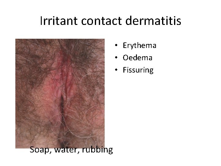 Irritant contact dermatitis • Erythema • Oedema • Fissuring Soap, water, rubbing 