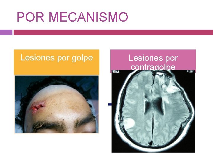 POR MECANISMO Lesiones por golpe Lesiones por contragolpe • Desgarros y contusiones extensas en