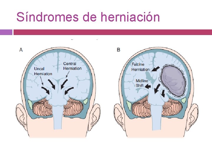 Síndromes de herniación 