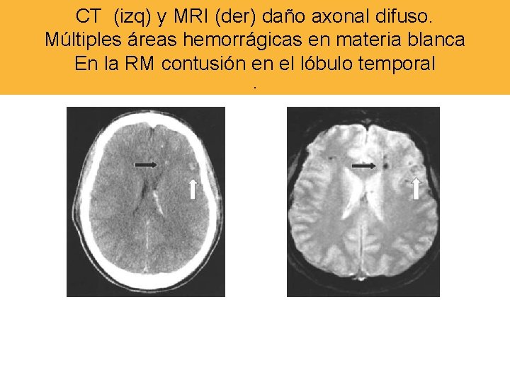 CT (izq) y MRI (der) daño axonal difuso. Múltiples áreas hemorrágicas en materia blanca