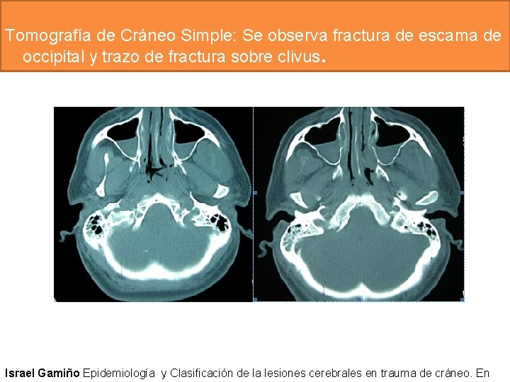 Tomografía de Cráneo Simple: Se observa fractura de escama de occipital y trazo de