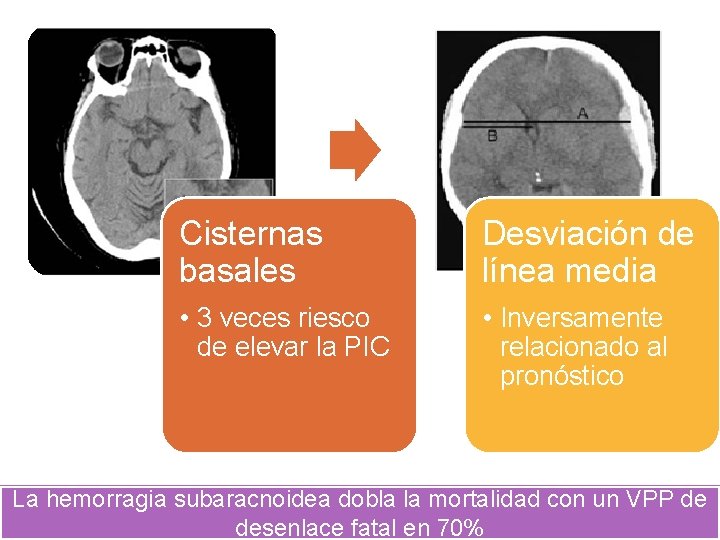 Cisternas basales Desviación de línea media • 3 veces riesco de elevar la PIC