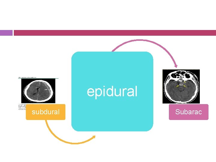 epidural subdural Subarac 