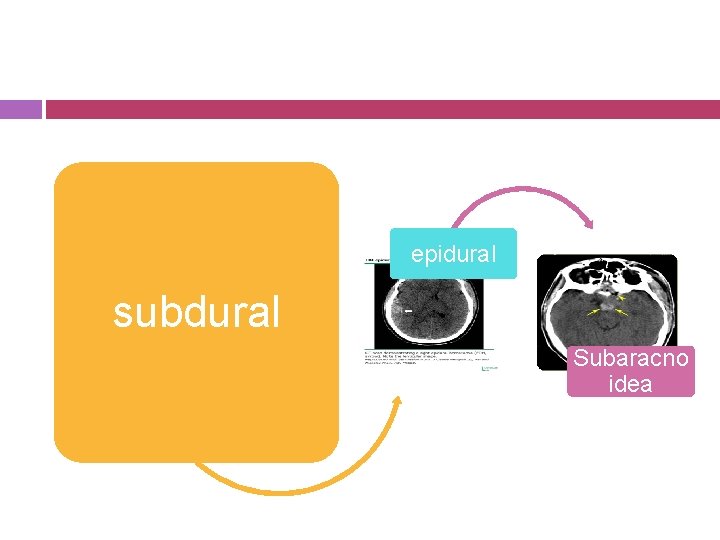 epidural subdural Subaracno idea 