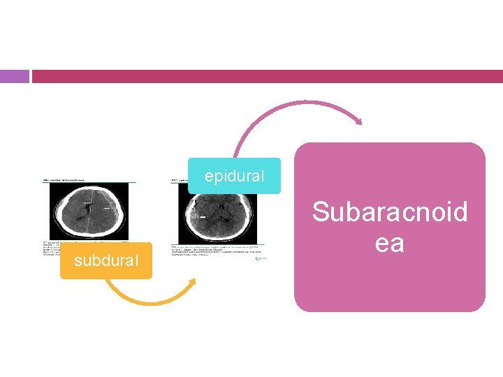 epidural subdural Subaracnoid ea 