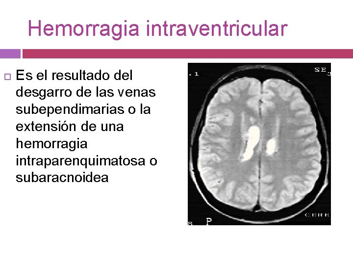 Hemorragia intraventricular Es el resultado del desgarro de las venas subependimarias o la extensión