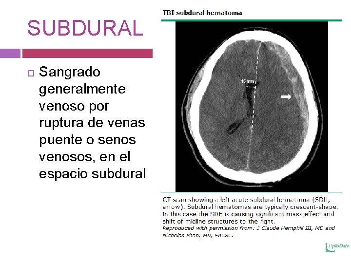 SUBDURAL Sangrado generalmente venoso por ruptura de venas puente o senos venosos, en el