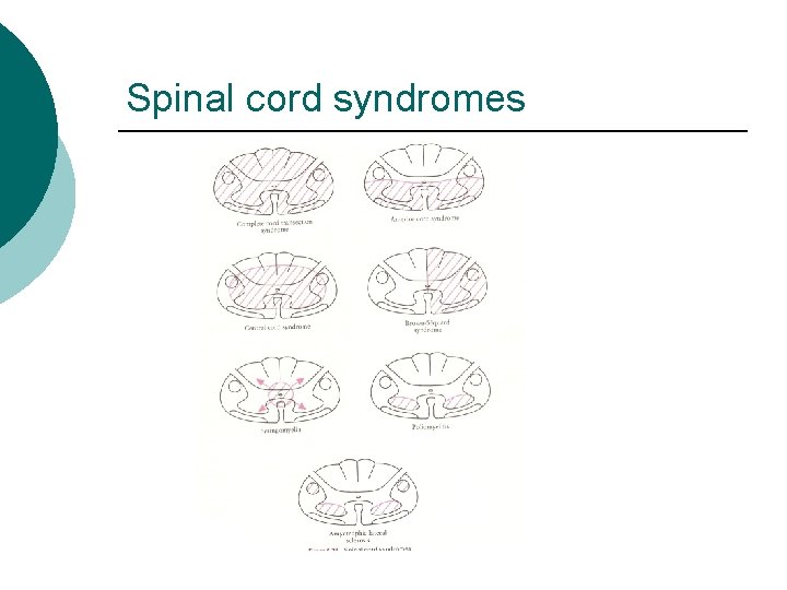 Spinal cord syndromes 