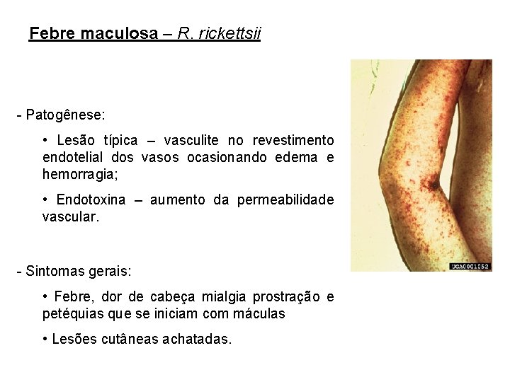 Febre maculosa – R. rickettsii - Patogênese: • Lesão típica – vasculite no revestimento