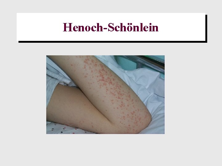 Henoch-Schönlein 