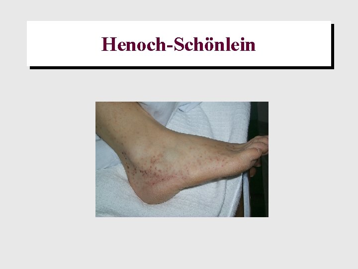 Henoch-Schönlein 
