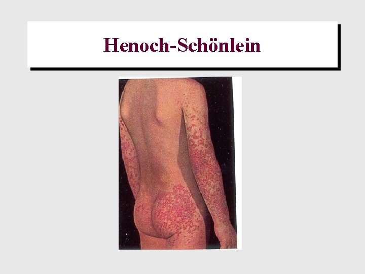 Henoch-Schönlein 