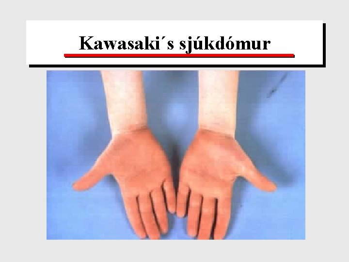 Kawasaki´s sjúkdómur 