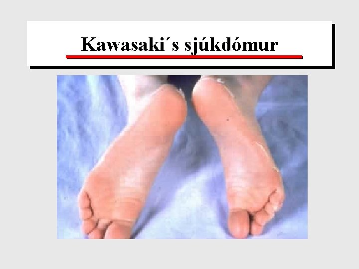 Kawasaki´s sjúkdómur 