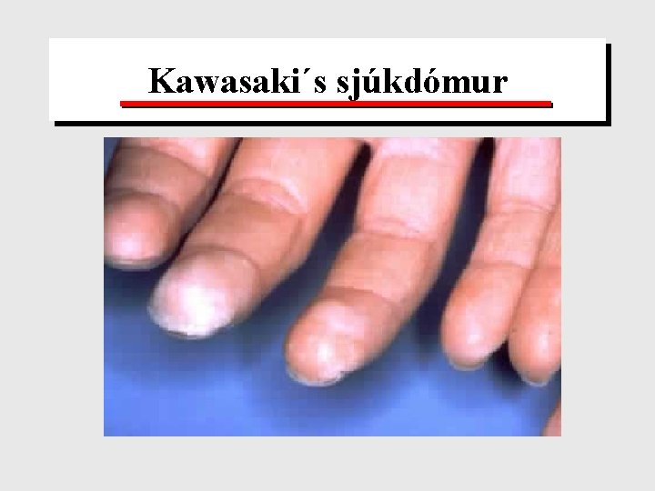 Kawasaki´s sjúkdómur 