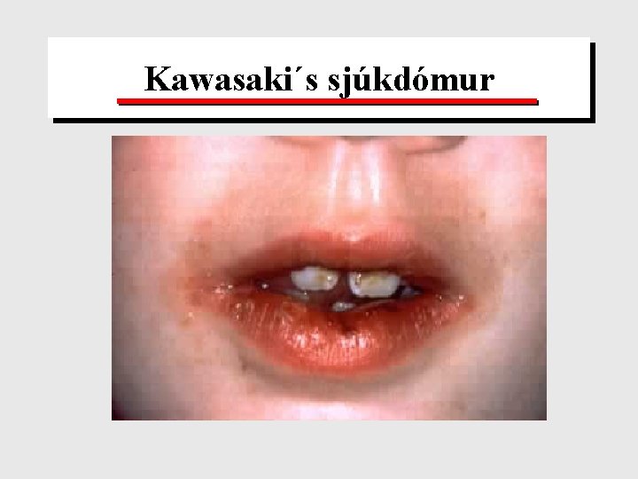 Kawasaki´s sjúkdómur 