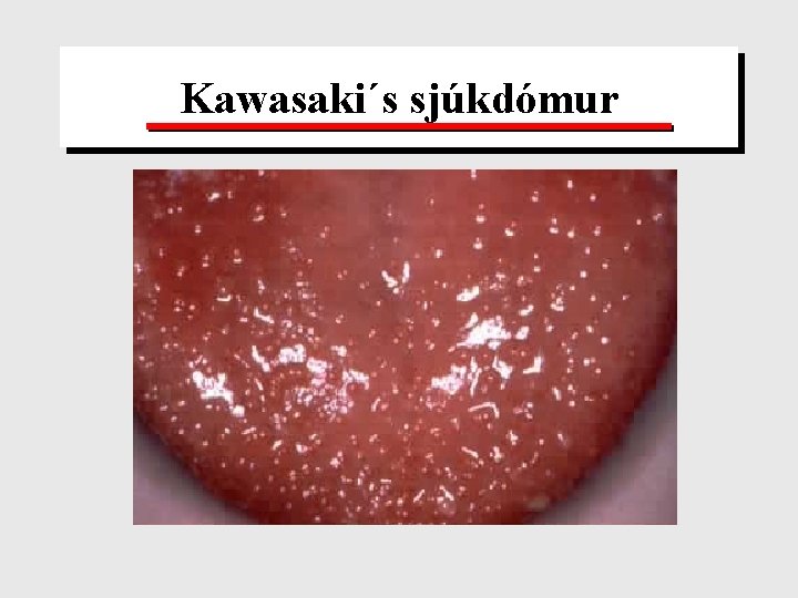 Kawasaki´s sjúkdómur 