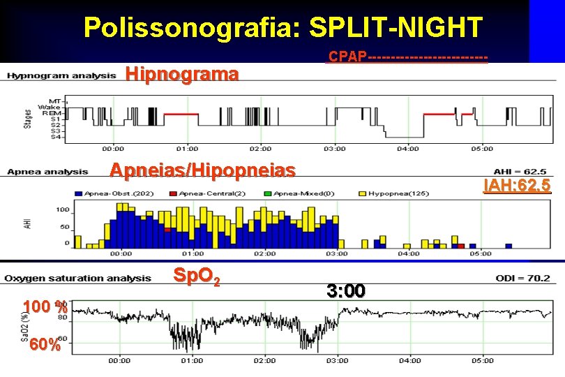 Polissonografia: SPLIT-NIGHT Hipnograma CPAP------------- Apneias/Hipopneias Sp. O 2 100 % IAH: 62, 5 3:
