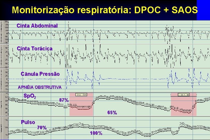 Monitorização respiratória: DPOC + SAOS Cinta Abdominal Cinta Torácica Cânula Pressão APNÉIA OBSTRUTIVA Sp.