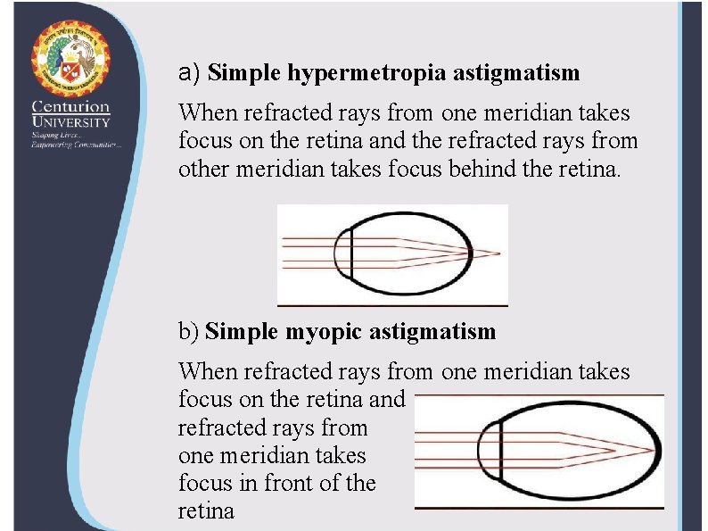 astigmatism hypermetropic definitie)