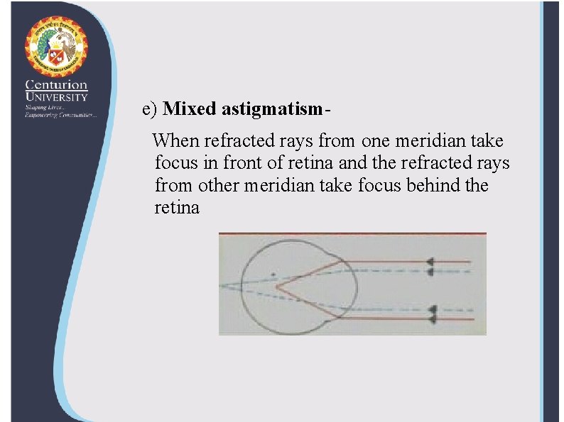 e) Mixed astigmatism. When refracted rays from one meridian take focus in front of