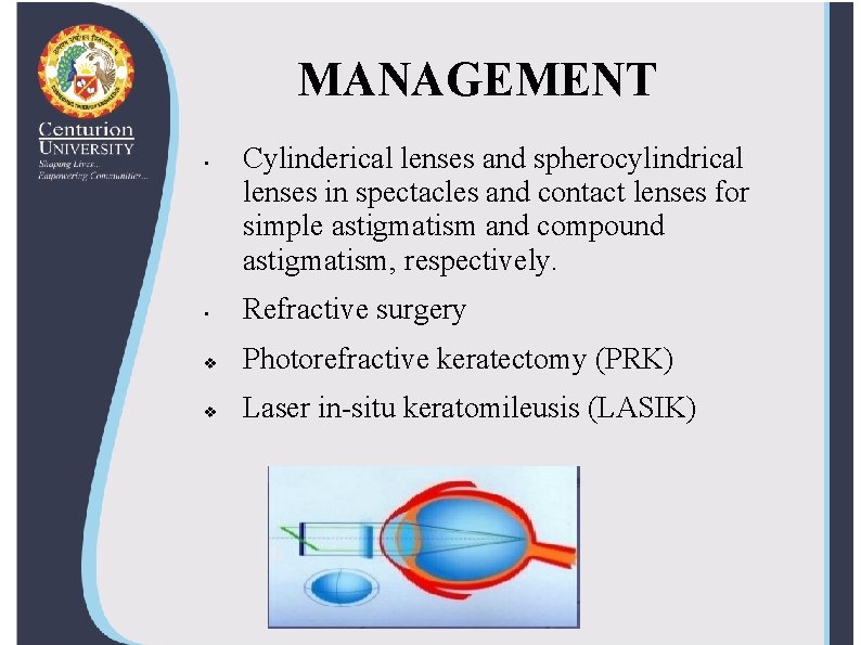 MANAGEMENT • Cylinderical lenses and spherocylindrical lenses in spectacles and contact lenses for simple