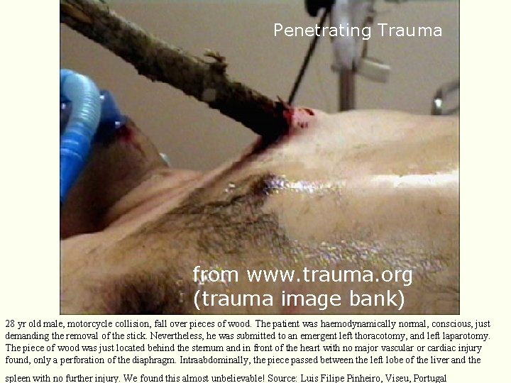 Penetrating Trauma from www. trauma. org (trauma image bank) 28 yr old male, motorcycle Penetrating Trauma from www. trauma. org (trauma image bank) 28 yr old male, motorcycle