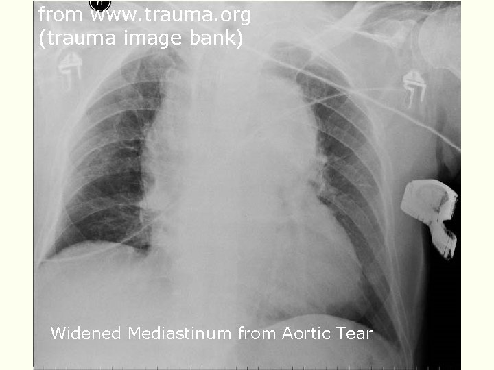 from www. trauma. org (trauma image bank) Widened Mediastinum from Aortic Tear from www. trauma. org (trauma image bank) Widened Mediastinum from Aortic Tear