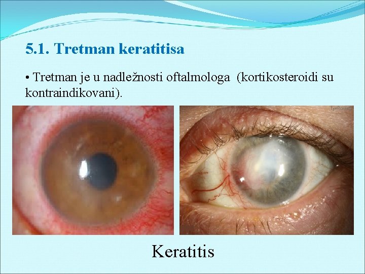 5. 1. Tretman keratitisa • Tretman je u nadležnosti oftalmologa (kortikosteroidi su kontraindikovani). Keratitis
