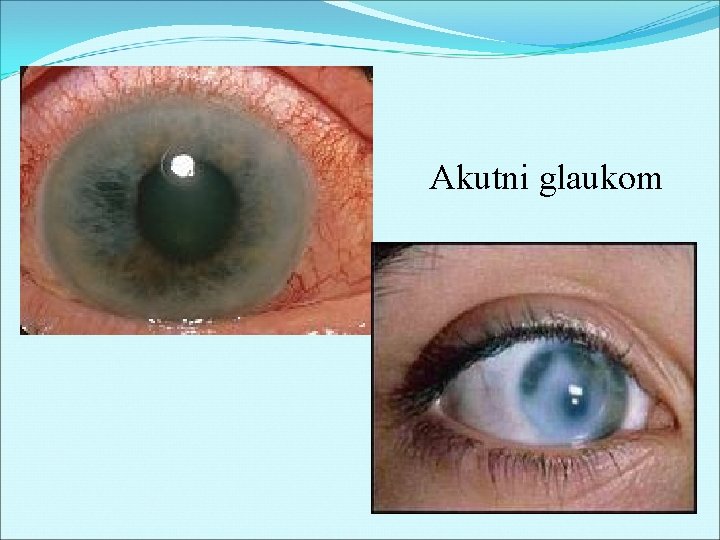 Akutni glaukom 