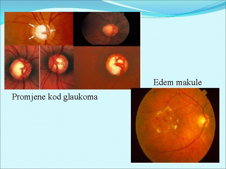 Edem makule Promjene kod glaukoma 