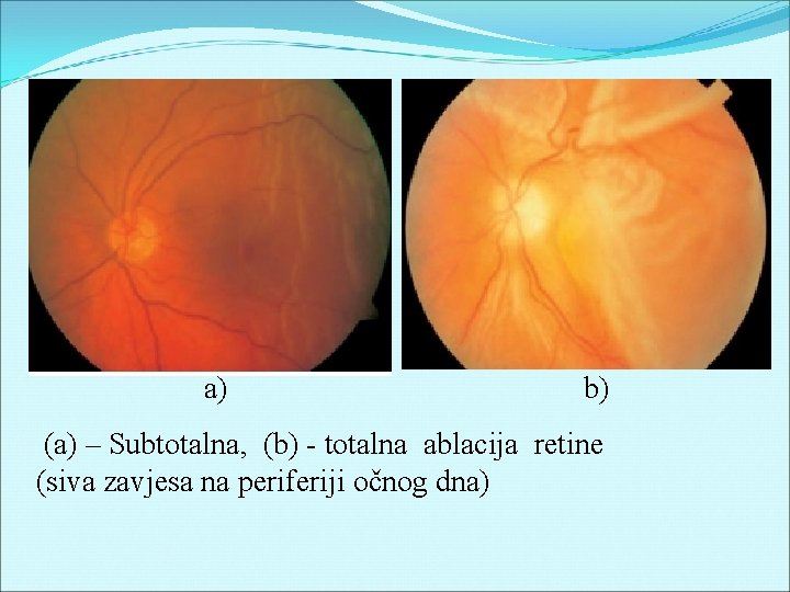 a) b) (a) – Subtotalna, (b) - totalna ablacija retine (siva zavjesa na periferiji