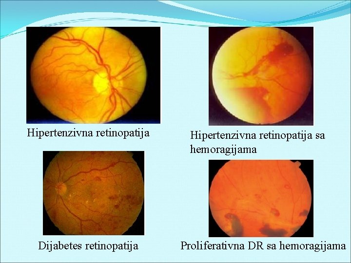 Hipertenzivna retinopatija Dijabetes retinopatija Hipertenzivna retinopatija sa hemoragijama Proliferativna DR sa hemoragijama 